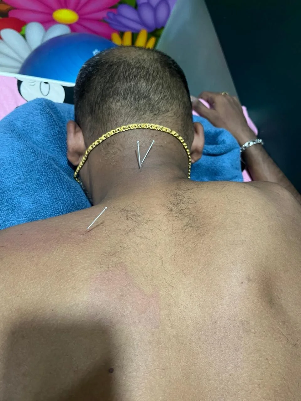 Cervical Spondylitis & Cervicogenic Headache